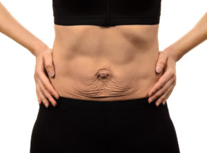 Mini-Bauchdeckenstraffung