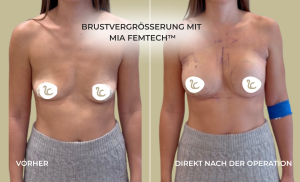 Mia Femtech Vorher/Nachher