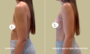 Mia Femtech Brustvergrösserung Vorher/Nachher