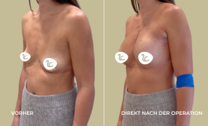 Mia Femtech Brustvergrösserung Vorher/Nachher