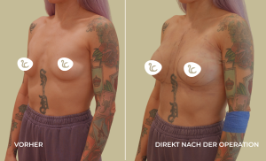 Mia Femtech Brustvergrösserung Vorher/Nachher