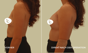 Mia Femtech Brustvergrösserung Vorher/Nachher