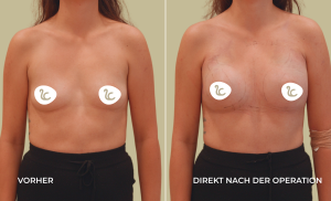 Mia Femtech Brustvergrösserung Vorher/Nachher