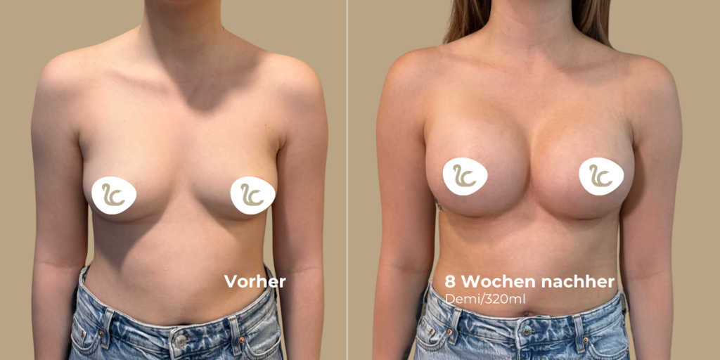 Vorher